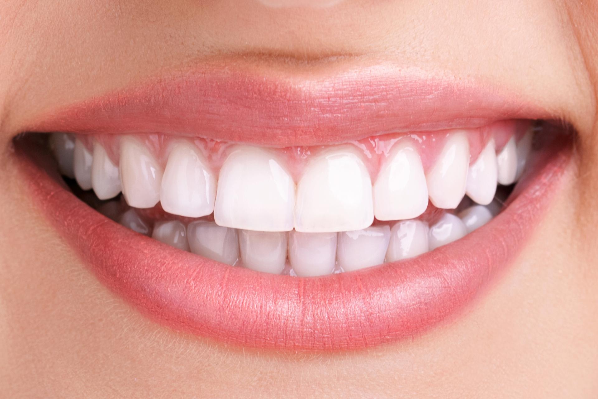 After Invisalign treatment by Dr. Ankita Mishra, Ranchi